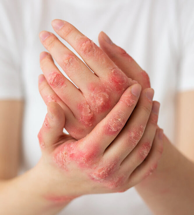Psoriasis