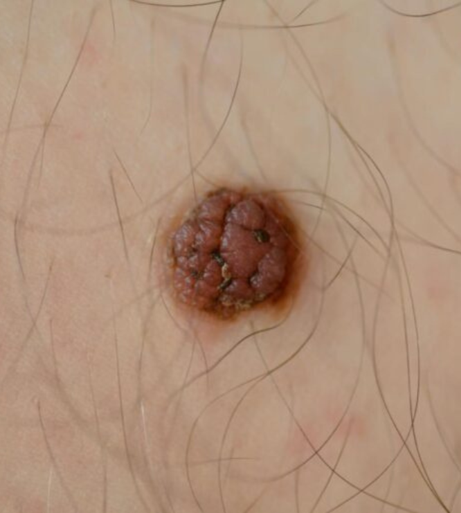 Moles