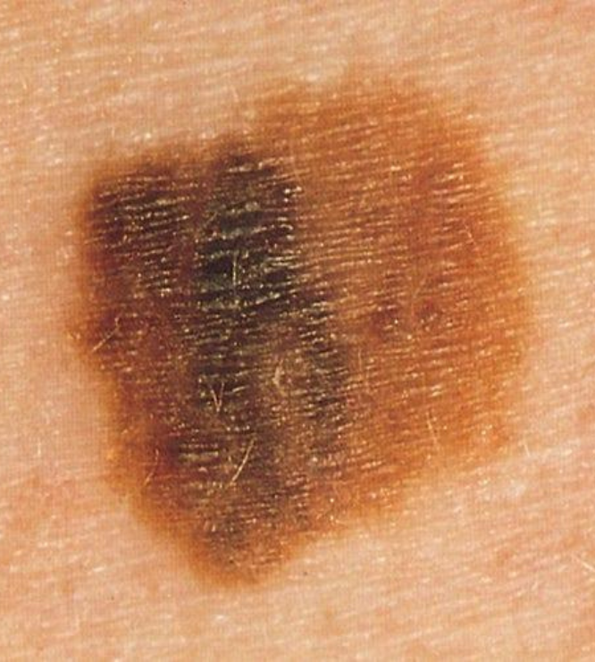 Skin cancer