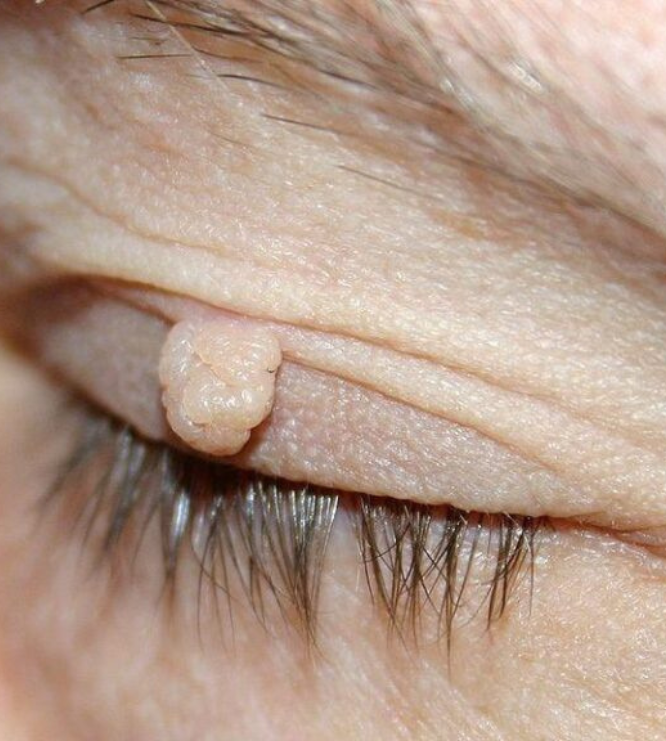 Skin tag