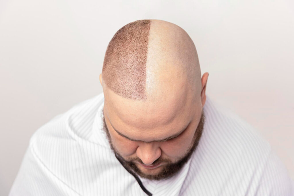 hair transplant